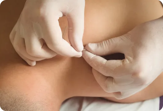 Dry needling treatment
