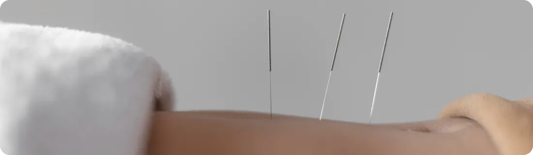Dry needling treatment